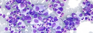 Micrograph of Hodgkin lymphoma